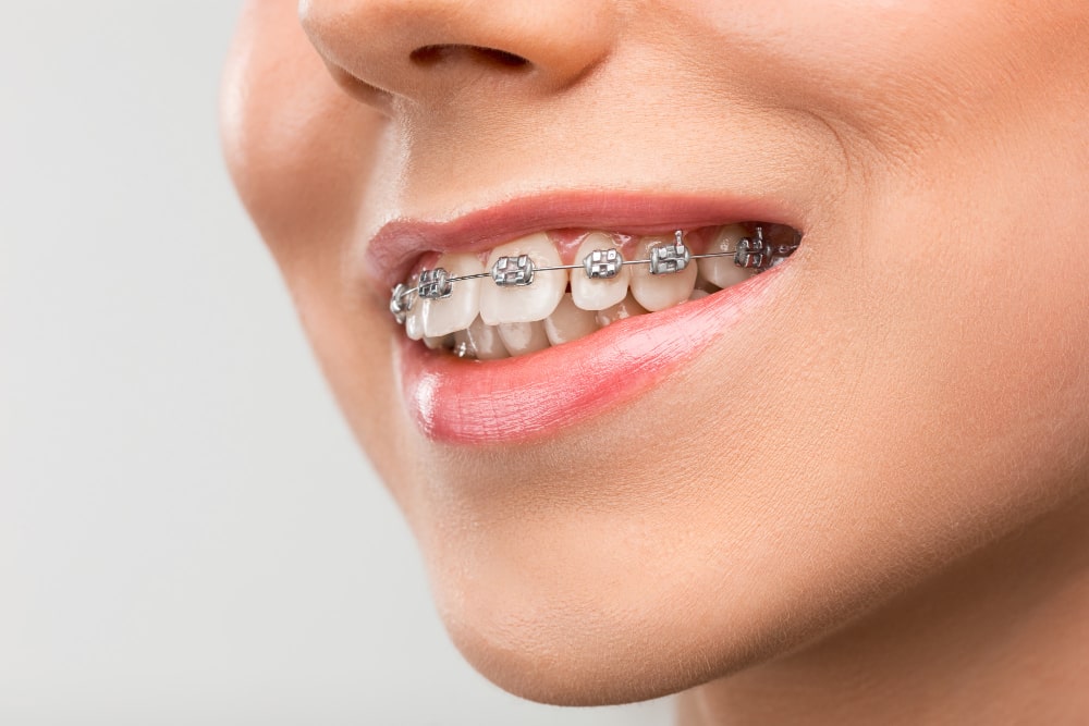 Orthodontics​ Dental