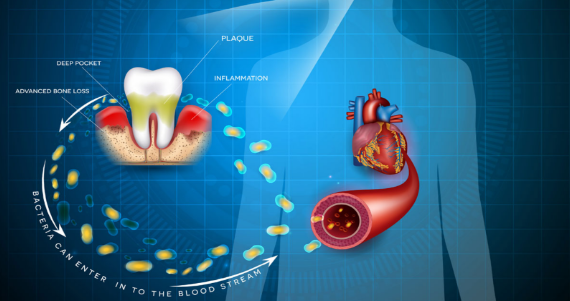 dental issues leads to heart problems