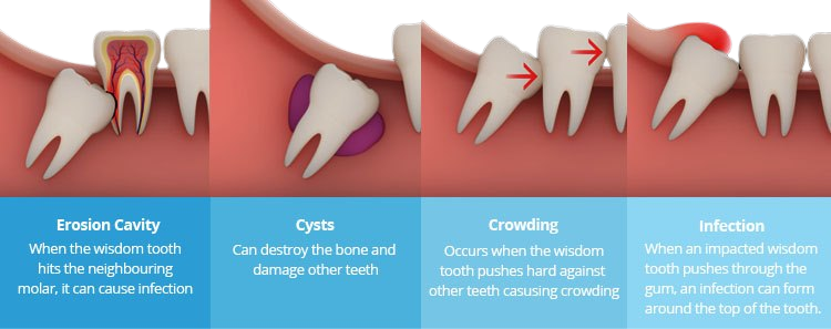 Impacted-Wisdom-Tooth-Types