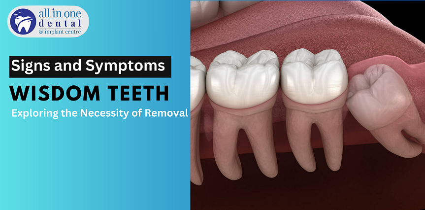 Wisdom Tooth Removal When Necessary