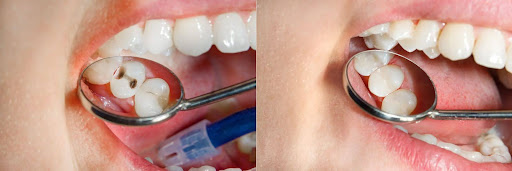 Understanding Dental Fillings