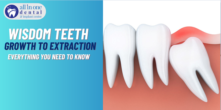 Everything You Need to Know About Wisdom Teeth: From Growth to Extraction