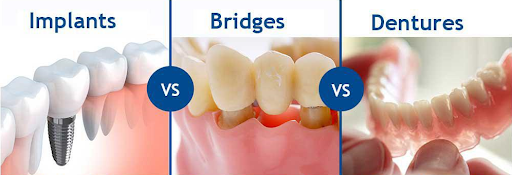 Dental Implants vs Denture vs Bridges