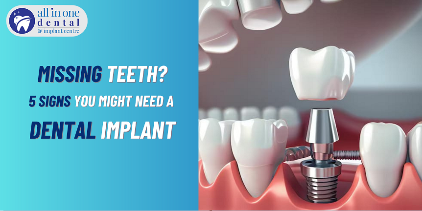 5 Signs You Might Need a Dental Implant