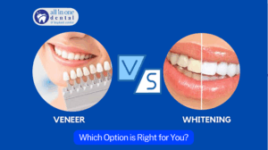 Veneers vs. Whitening: Which Option is Right for You?