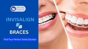 Invisalign vs. Braces: Which Is Right for You?