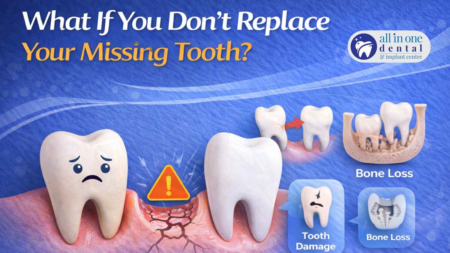 Missing a Tooth? Here’s What Happens If You Don’t Replace It