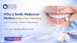 Why a Smile Makeover Matters Before Your Wedding