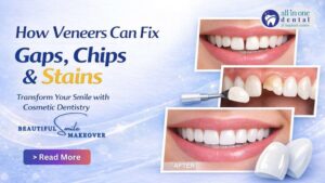 How Veneers Can Fix Gaps, Chips and Stains
