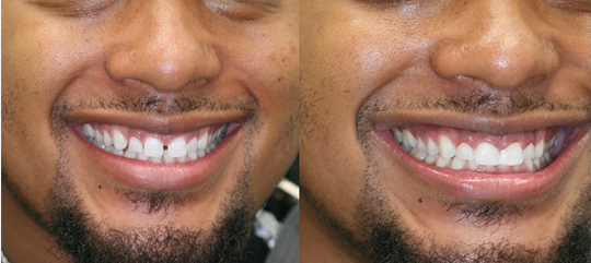 Dental-bonding-spearwood